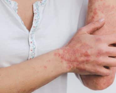 Psoriasis Diet Plan for Glowing Skin (Printable)
