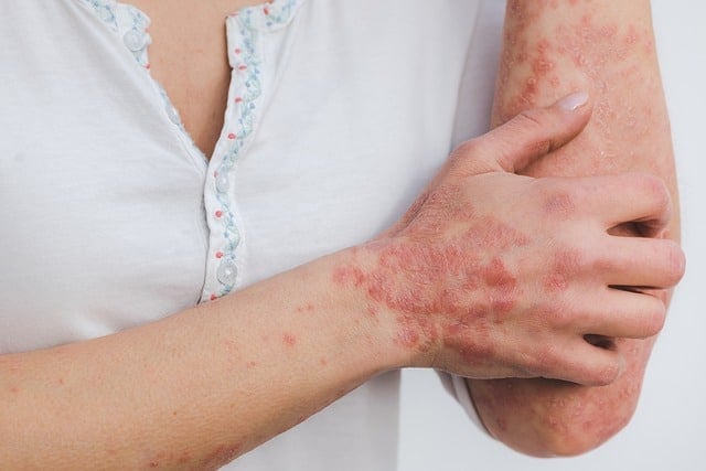 Psoriasis Diet Plan