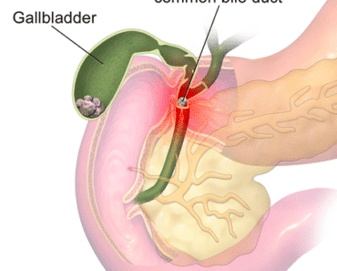 8 Foods That are Bad for Gallbladder