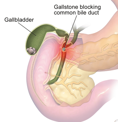 Foods That are Bad for Gallbladder