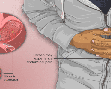 Printable Ulcer Diet Food List – Protect Your Stomach