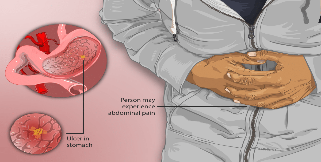 Printable Ulcer Diet Food List Protect Your Stomach