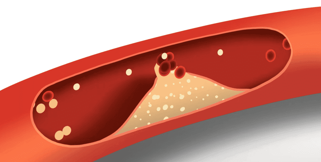 Keto Diet and High Cholesterol