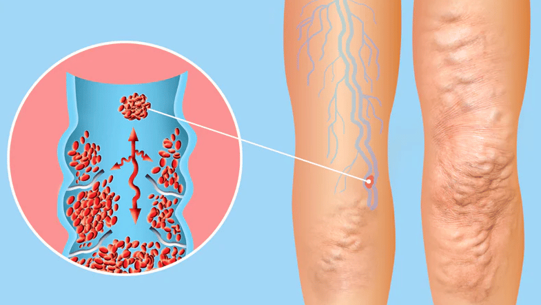 HCG Diet Side Effects