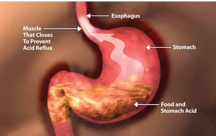 List of Foods to Eat With Acid Reflux