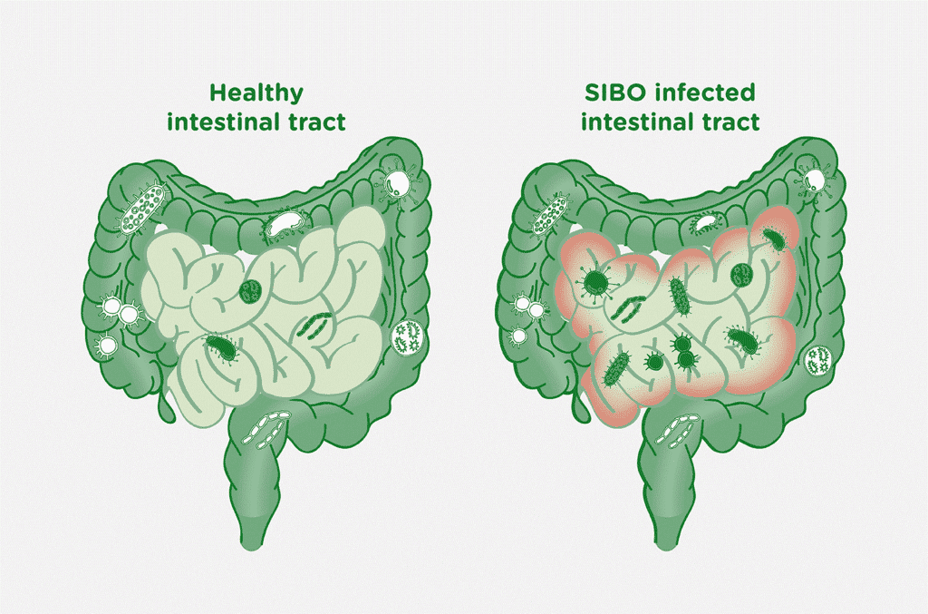 SIBO Diet Plan