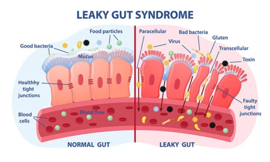 Leaky Gut Diet