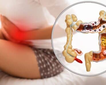 What is Diverticulitis?