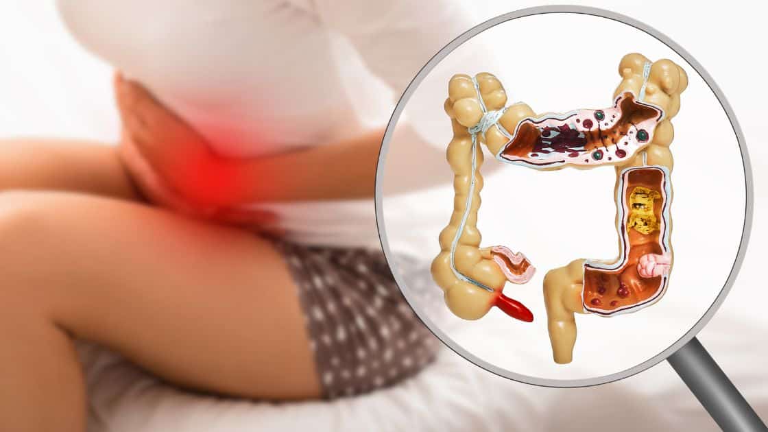What is Diverticulitis